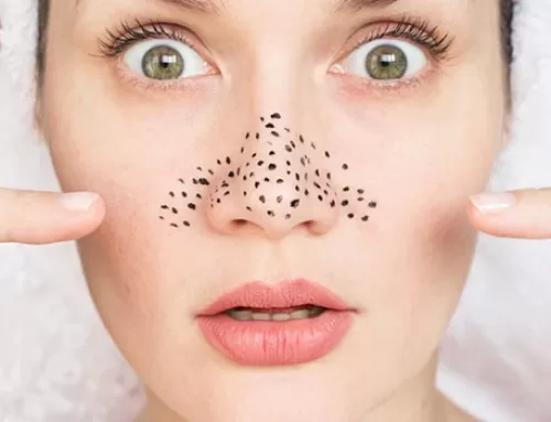 How to get rid of blackheads.